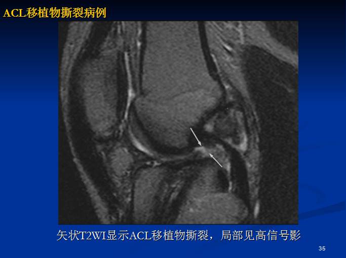 半月板和前交叉韧带术后的MRI评价