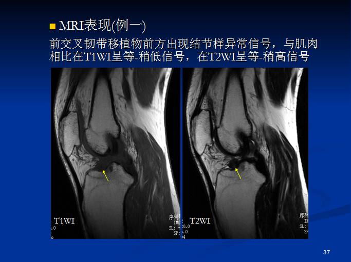 半月板和前交叉韧带术后的MRI评价