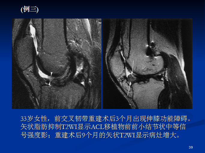 半月板和前交叉韧带术后的MRI评价