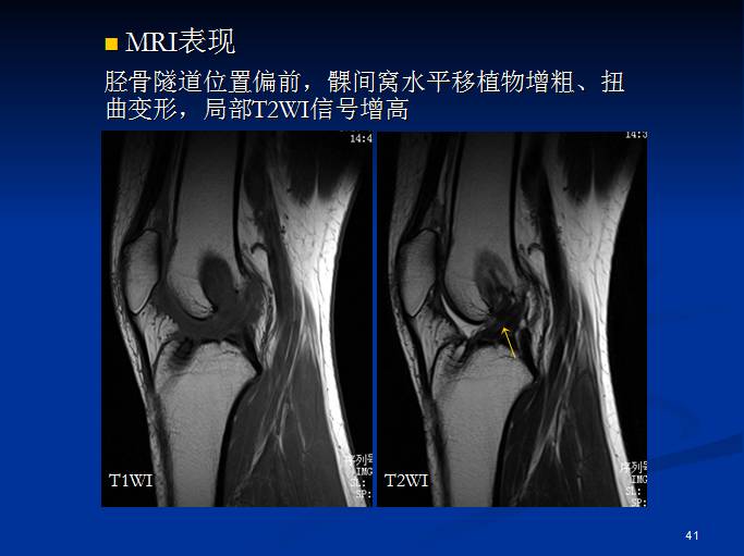 半月板和前交叉韧带术后的MRI评价