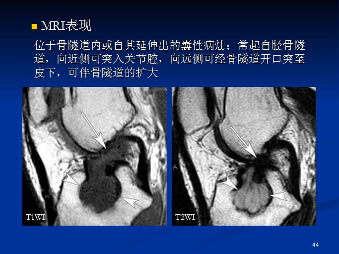 半月板和前交叉韧带术后的MRI评价