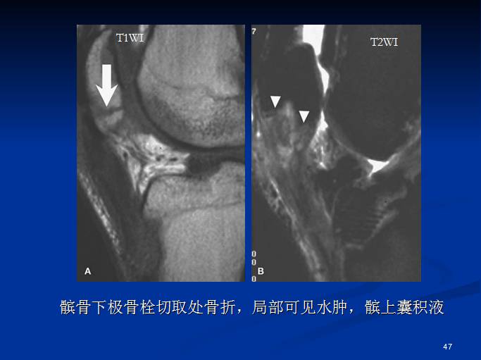 半月板和前交叉韧带术后的MRI评价