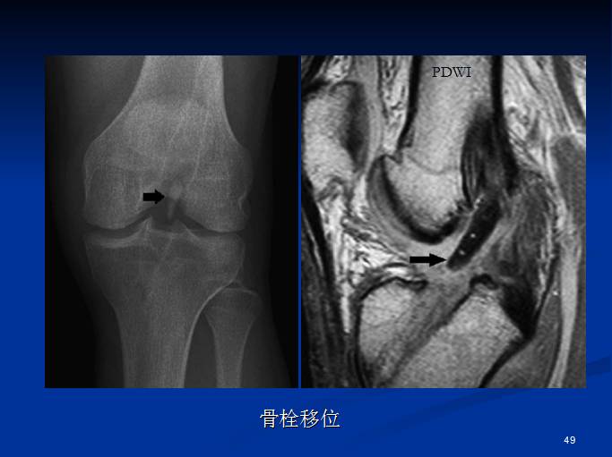 半月板和前交叉韧带术后的MRI评价