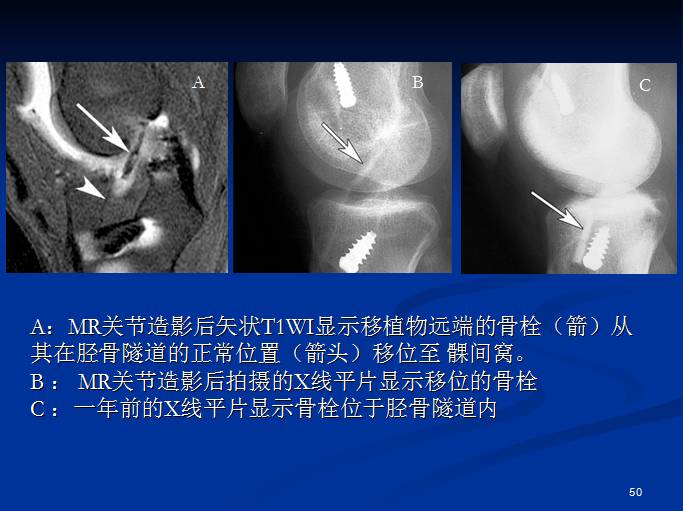 半月板和前交叉韧带术后的MRI评价