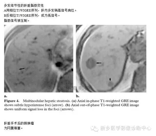 肝内含脂性良性病变