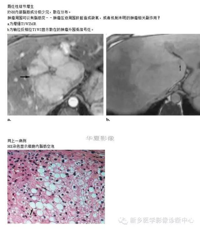 肝内含脂性良性病变