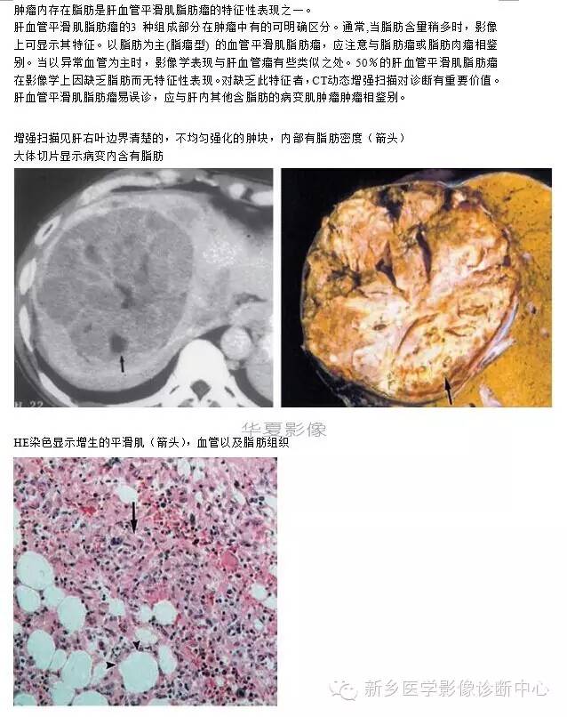 肝内含脂性良性病变