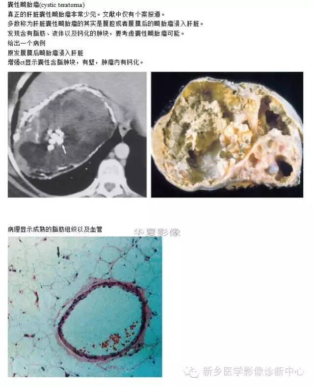 肝内含脂性良性病变
