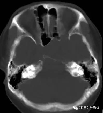 【病例学习】垂体瘤一例CT诊断 【病例学习】垂体瘤一例CT诊断