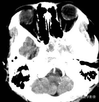 【病例学习】垂体瘤一例CT诊断 【病例学习】垂体瘤一例CT诊断