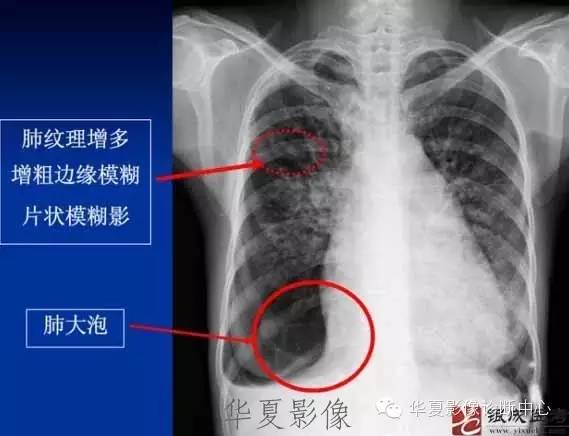 不同类型肺水肿的CT表现