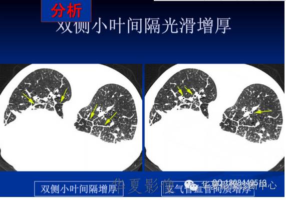 不同类型肺水肿的CT表现 不同类型肺水肿的CT表现