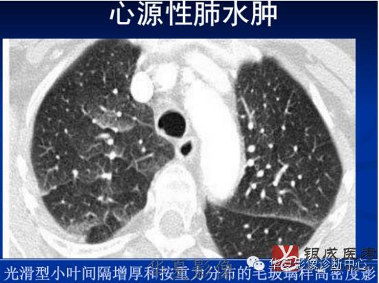 不同类型肺水肿的CT表现 不同类型肺水肿的CT表现