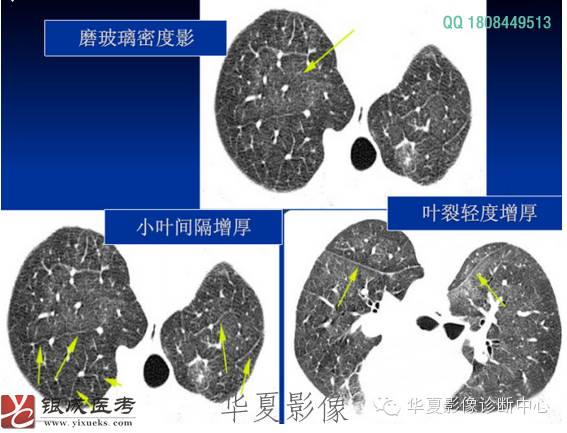 不同类型肺水肿的CT表现 不同类型肺水肿的CT表现