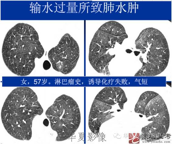 不同类型肺水肿的CT表现 不同类型肺水肿的CT表现