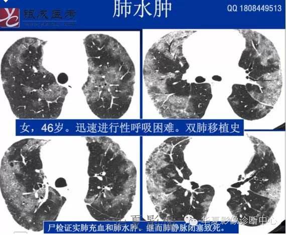 不同类型肺水肿的CT表现 不同类型肺水肿的CT表现