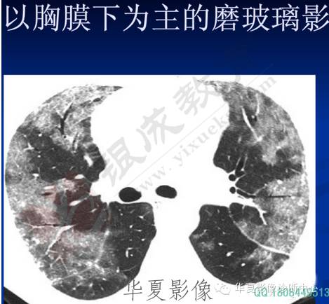 不同类型肺水肿的CT表现 不同类型肺水肿的CT表现