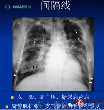 不同类型肺水肿的CT表现 不同类型肺水肿的CT表现