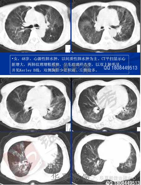 不同类型肺水肿的CT表现 不同类型肺水肿的CT表现