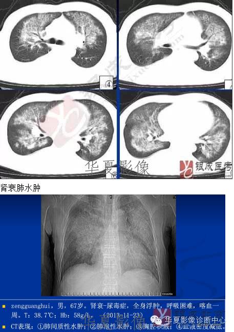 不同类型肺水肿的CT表现 不同类型肺水肿的CT表现