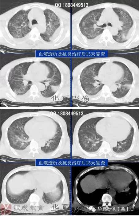 不同类型肺水肿的CT表现 不同类型肺水肿的CT表现