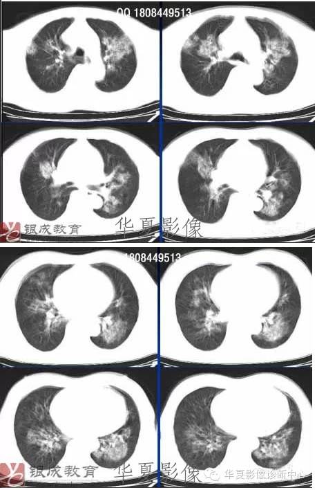 不同类型肺水肿的CT表现 不同类型肺水肿的CT表现