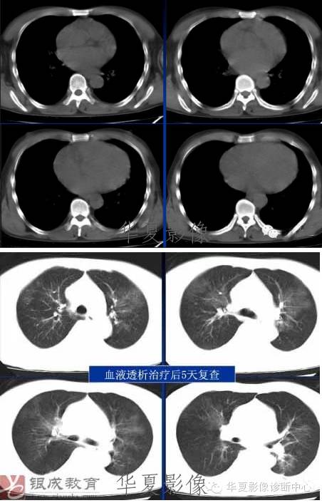 不同类型肺水肿的CT表现 不同类型肺水肿的CT表现