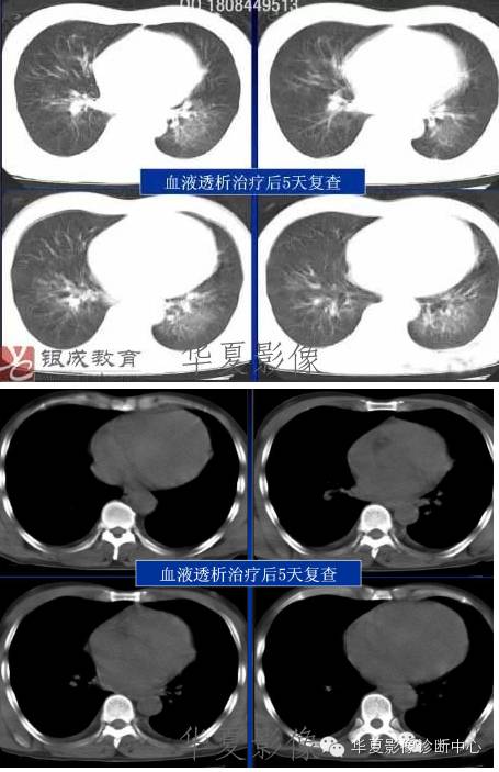 不同类型肺水肿的CT表现 不同类型肺水肿的CT表现