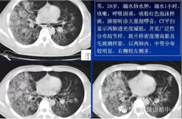 不同类型肺水肿的CT表现 不同类型肺水肿的CT表现