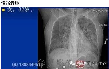 不同类型肺水肿的CT表现 不同类型肺水肿的CT表现