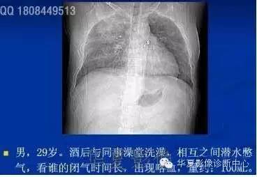 不同类型肺水肿的CT表现 不同类型肺水肿的CT表现