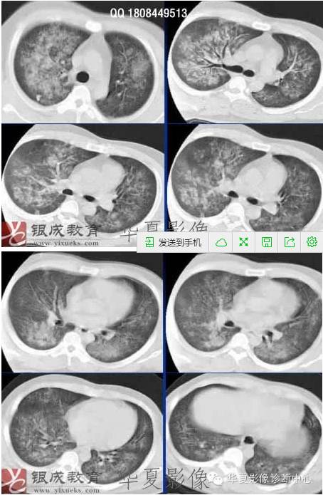 不同类型肺水肿的CT表现 不同类型肺水肿的CT表现
