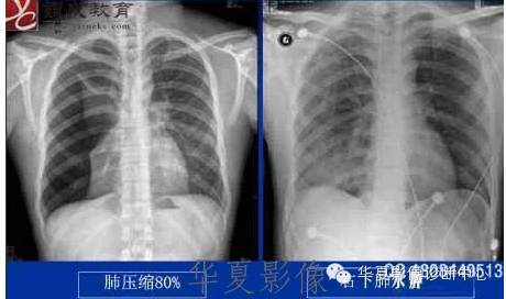 不同类型肺水肿的CT表现 不同类型肺水肿的CT表现