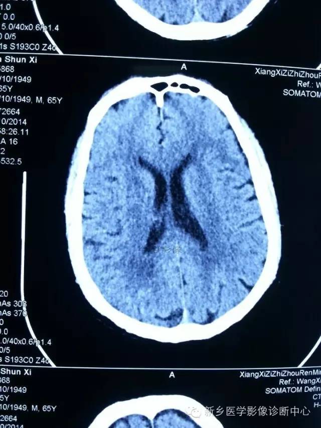 【病例学习】梗死中的T1高信号,也许不一定是出血 【病例学习】梗死中的T1高信号,也许不一定是出血