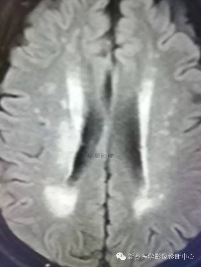 【病例学习】梗死中的T1高信号,也许不一定是出血 【病例学习】梗死中的T1高信号,也许不一定是出血