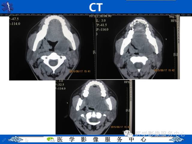 【病例学习】咽旁多形性腺瘤一例MR影像学表现