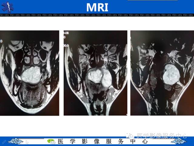 【病例学习】咽旁多形性腺瘤一例MR影像学表现