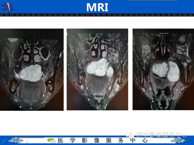【病例学习】咽旁多形性腺瘤一例MR影像学表现