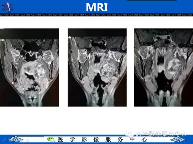 【病例学习】咽旁多形性腺瘤一例MR影像学表现