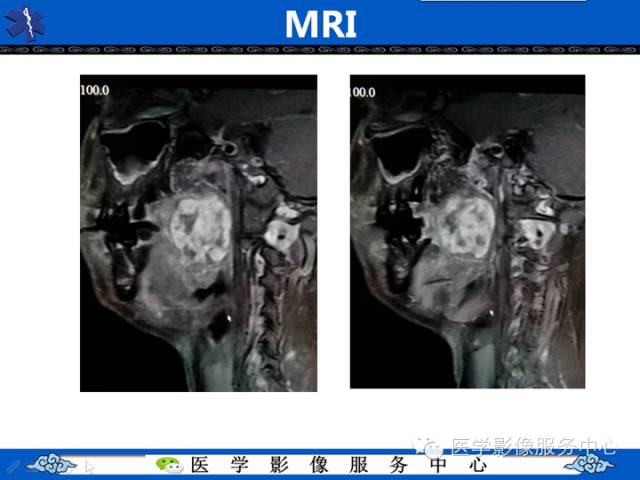 【病例学习】咽旁多形性腺瘤一例MR影像学表现