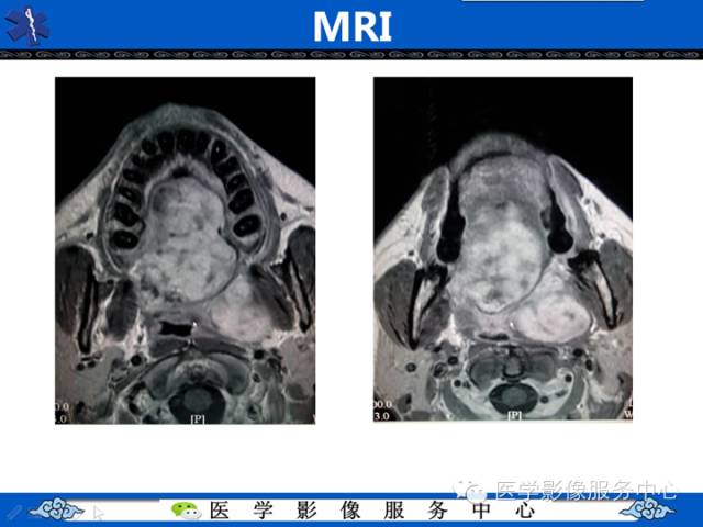【病例学习】咽旁多形性腺瘤一例MR影像学表现