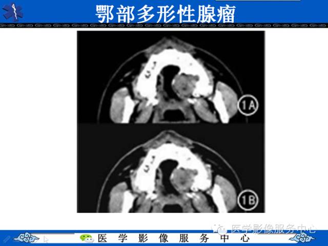 【病例学习】咽旁多形性腺瘤一例MR影像学表现