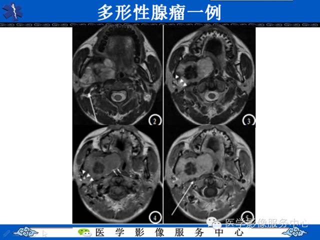【病例学习】咽旁多形性腺瘤一例MR影像学表现