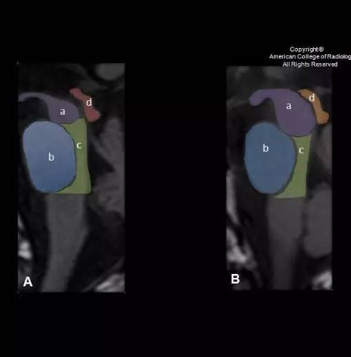 【病例学习】进行性核上性麻痹在 MRI上的征象分析