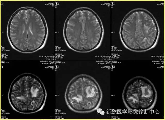 【病例学习】静脉窦血栓一例MR影像学表现