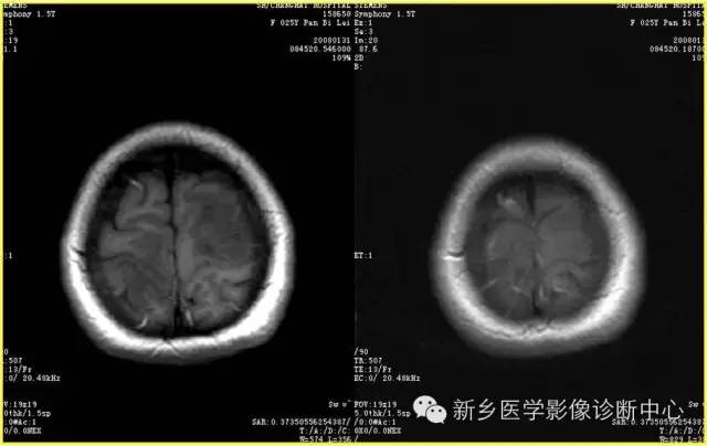 【病例学习】静脉窦血栓一例MR影像学表现
