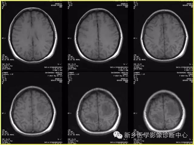 【病例学习】静脉窦血栓一例MR影像学表现