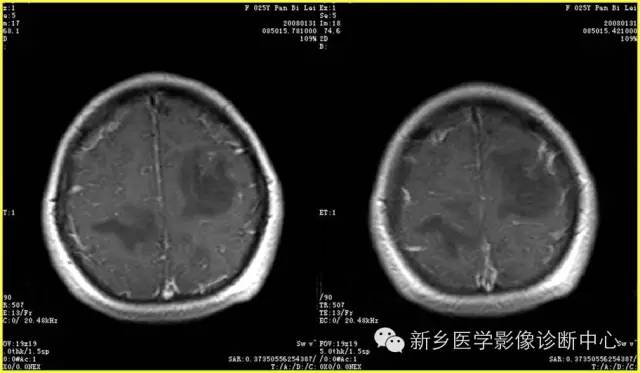 【病例学习】静脉窦血栓一例MR影像学表现