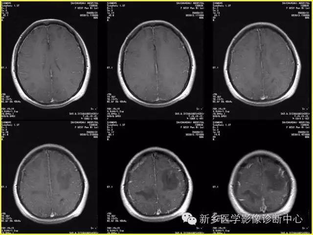 【病例学习】静脉窦血栓一例MR影像学表现