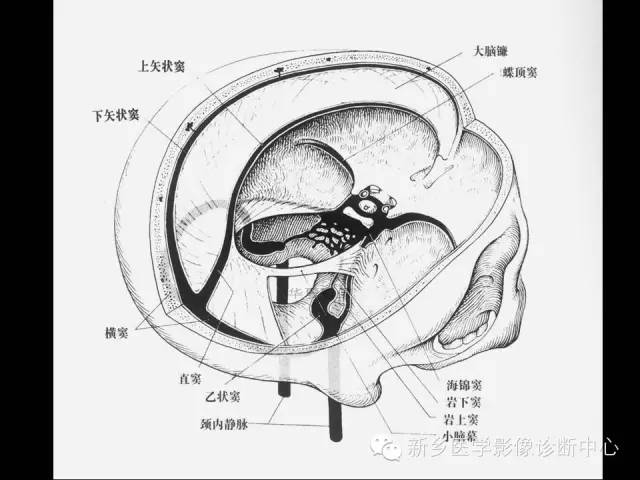【病例学习】静脉窦血栓一例MR影像学表现